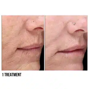 Halo laser before and after