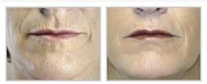 profractional laser treatment