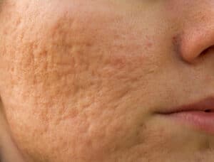 skin texture on the face - acne scarring