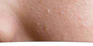 skin texture on the face - sebaceous hyperplasia