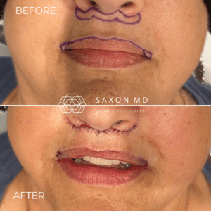 corner lip lift incisions