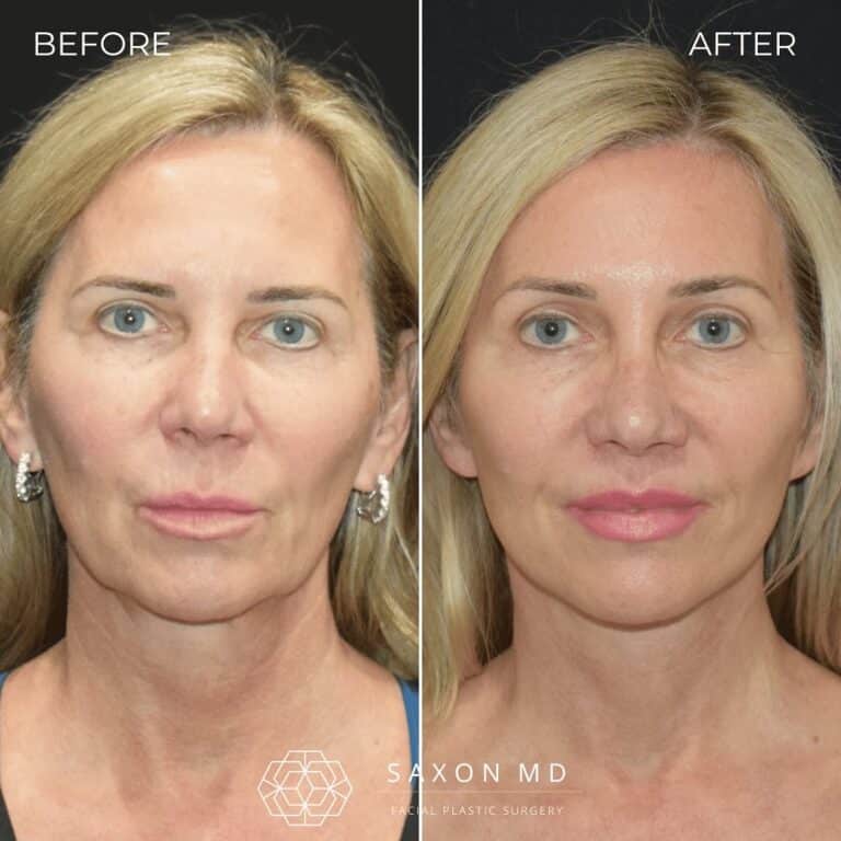 Before and after deep plane facelift, front view, by Austin facial plastic surgeon Dr. Sarah Saxon