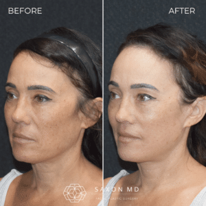 deep plane facelift before and after photo at Saxon MD in Austin and Dallas, TX; deep plane facelift 40s