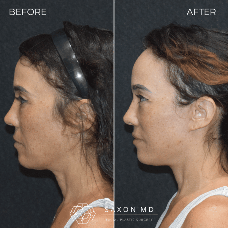 Before and after deep plane facelift, side profile, by Austin facial plastic surgeon Dr. Sarah Saxon