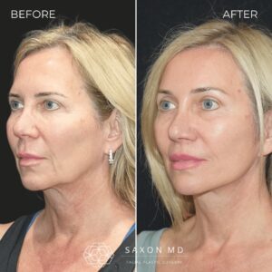 deep plane facelift before and after photo at Saxon MD in Austin and Dallas, TX; deep plane facelift 40s