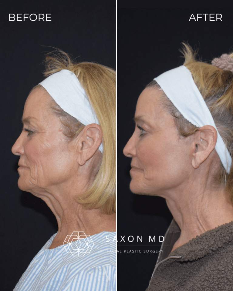 Before and after deep plane facelift, side profile, by Austin facial plastic surgeon Dr. Sarah Saxon