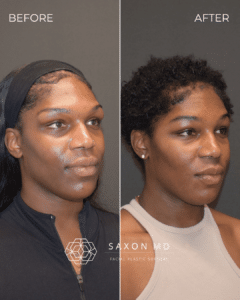 brow bone reduction before and after photo and Saxon MD in Austin and Dallas, TX; forehead contouring, forehead reduction, facial feminization surgery; hooded eyes