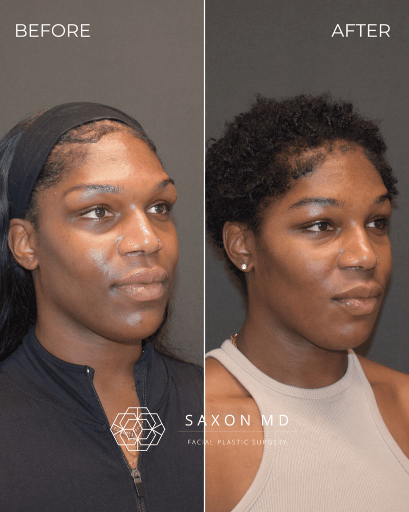 Brow Bone Reduction 50 brow bone reduction before and after photo and Saxon MD in Austin and Dallas, TX; forehead contouring, forehead reduction, facial feminization surgery