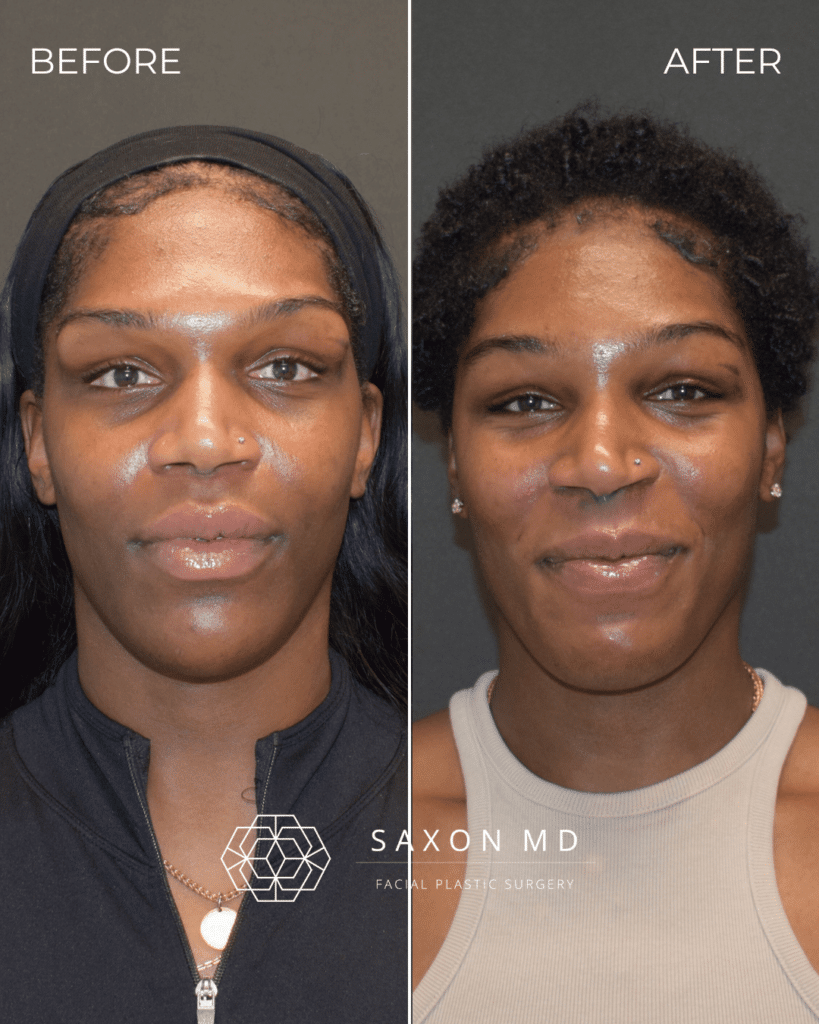 Brow Bone Reduction 52 brow bone reduction before and after photo and Saxon MD in Austin and Dallas, TX; forehead contouring, forehead reduction, facial feminization surgery