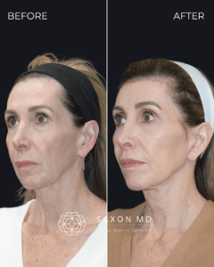 How Long Does a Deep Plane Facelift Last? 3 deep plane facelift before and after photos from Saxon MD in Austin and Dallas, TX; facelift austin; how long does deep plane facelift last