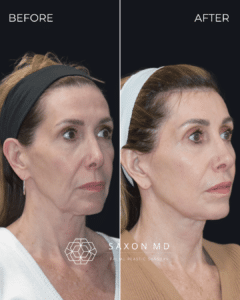 deep plane facelift before and after photos from Saxon MD in Austin and Dallas, TX; facelift austin; deep plane facelift cost