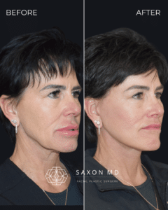 Deep plane facelift before and after Austin and Dallas, TX; rhytids; ponytail lift vs deep plane facelift