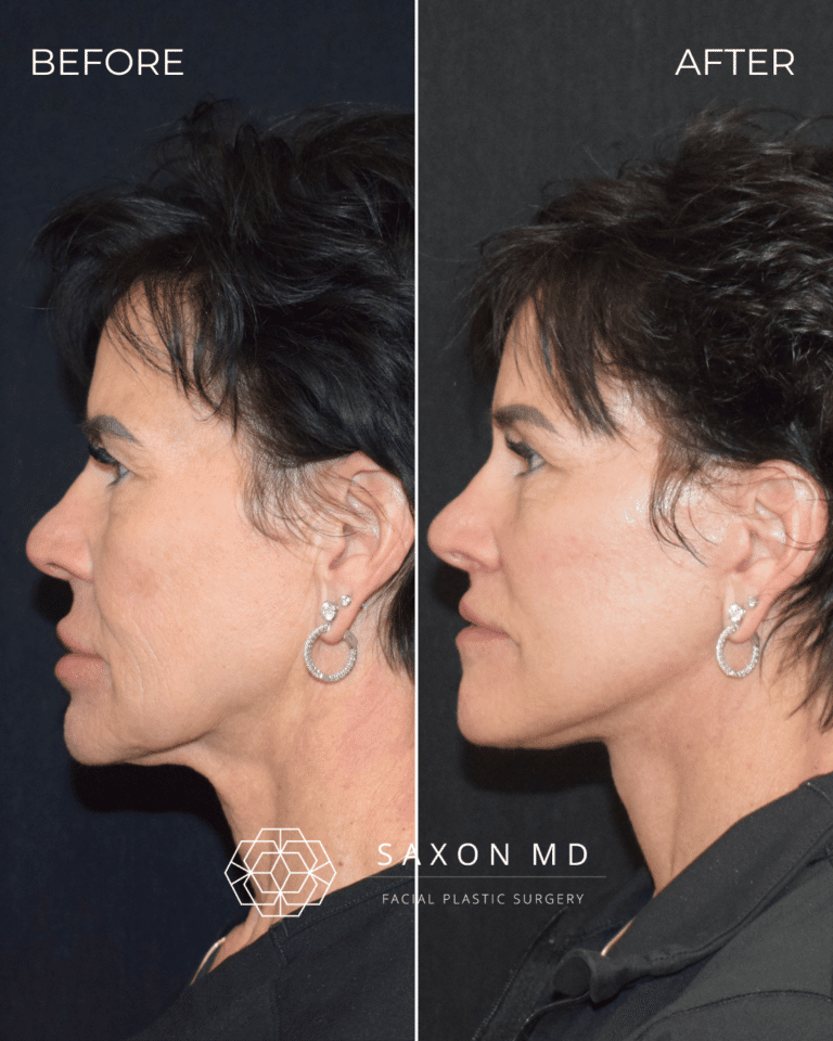 Before and after deep plane facelift, side profile, by Austin facial plastic surgeon Dr. Sarah Saxon