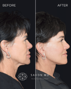 Deep plane facelift before and after Austin and Dallas, TX; side profile