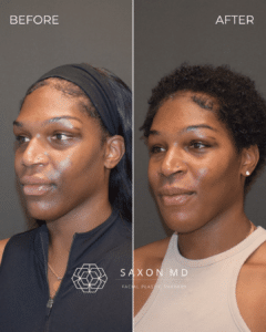 brow bone reduction before and after photo and Saxon MD in Austin and Dallas, TX; forehead contouring, forehead reduction, facial feminization surgery