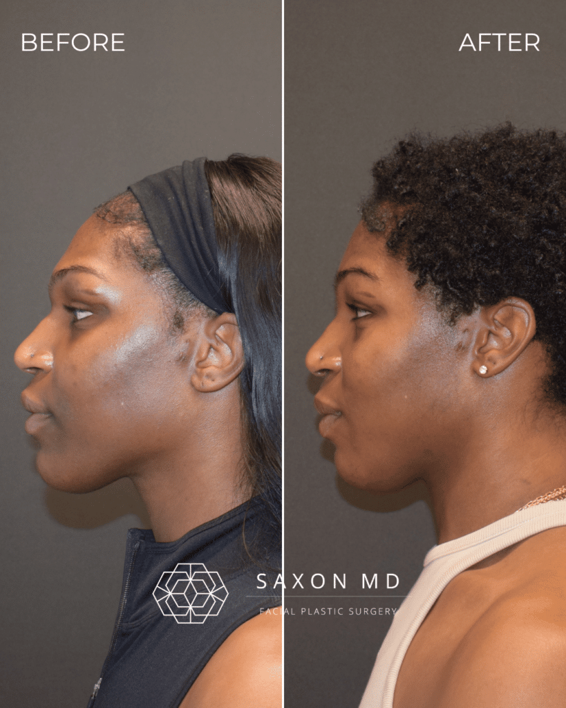 Brow Bone Reduction 53 brow bone reduction before and after photo and Saxon MD in Austin and Dallas, TX; forehead contouring, forehead reduction, facial feminization surgery