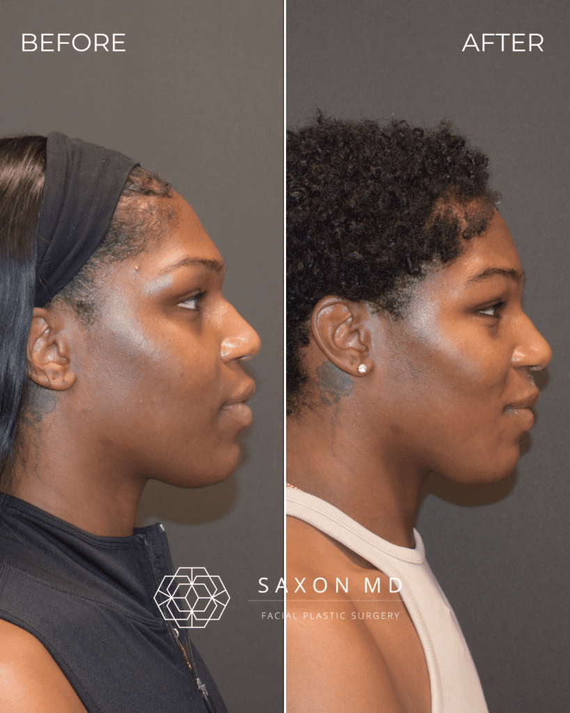 Brow Bone Reduction 51 brow bone reduction before and after photo and Saxon MD in Austin and Dallas, TX; forehead contouring, forehead reduction, facial feminization surgery