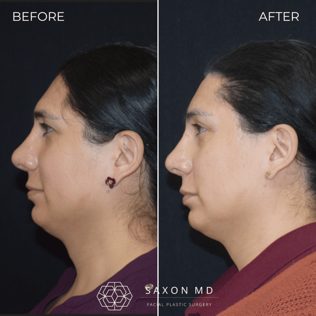 Brow Bone Reduction 56 brow bone reduction before and after photos from Saxon MD in Austin and Dallas, TX