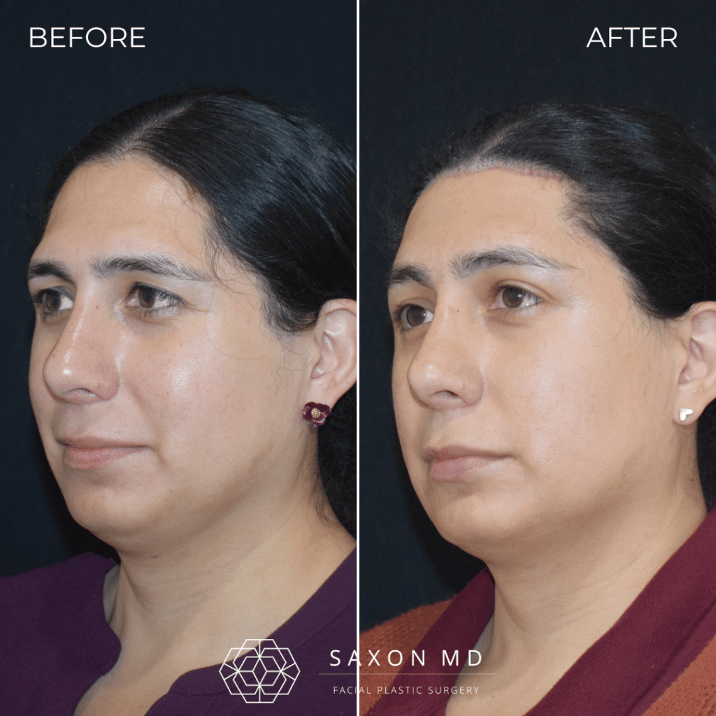 Brow Bone Reduction 57 brow bone reduction before and after photos from Saxon MD in Austin and Dallas, TX