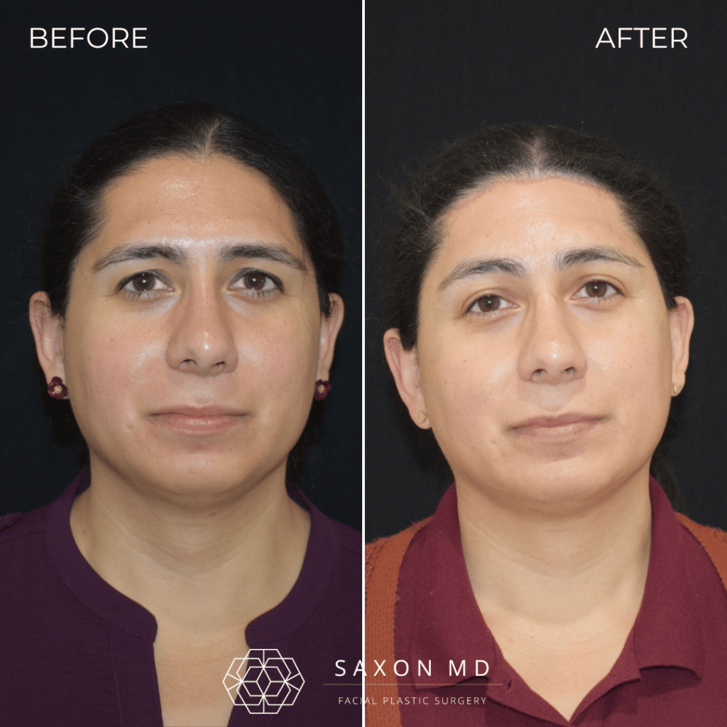 Brow Bone Reduction 58 brow bone reduction before and after photos from Saxon MD in Austin and Dallas, TX