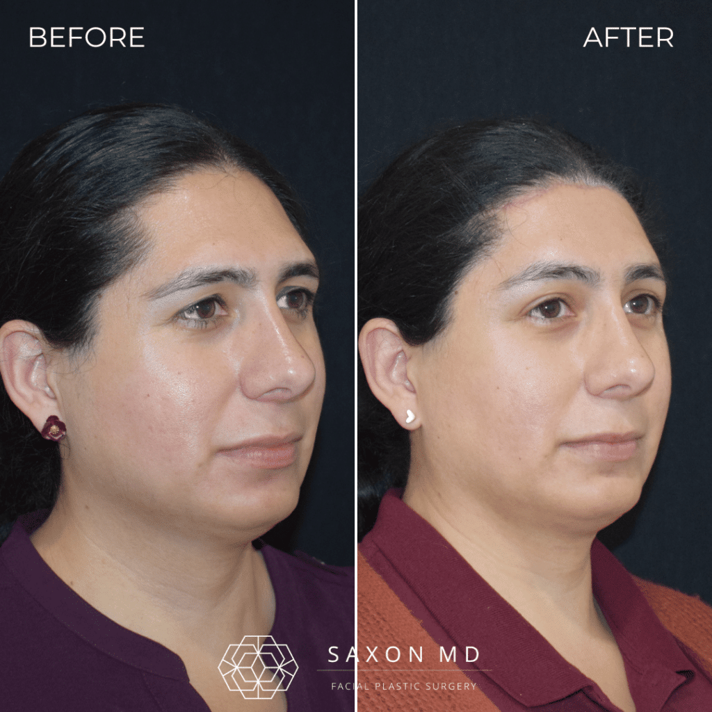 Brow Bone Reduction 55 brow bone reduction before and after photos from Saxon MD in Austin and Dallas, TX