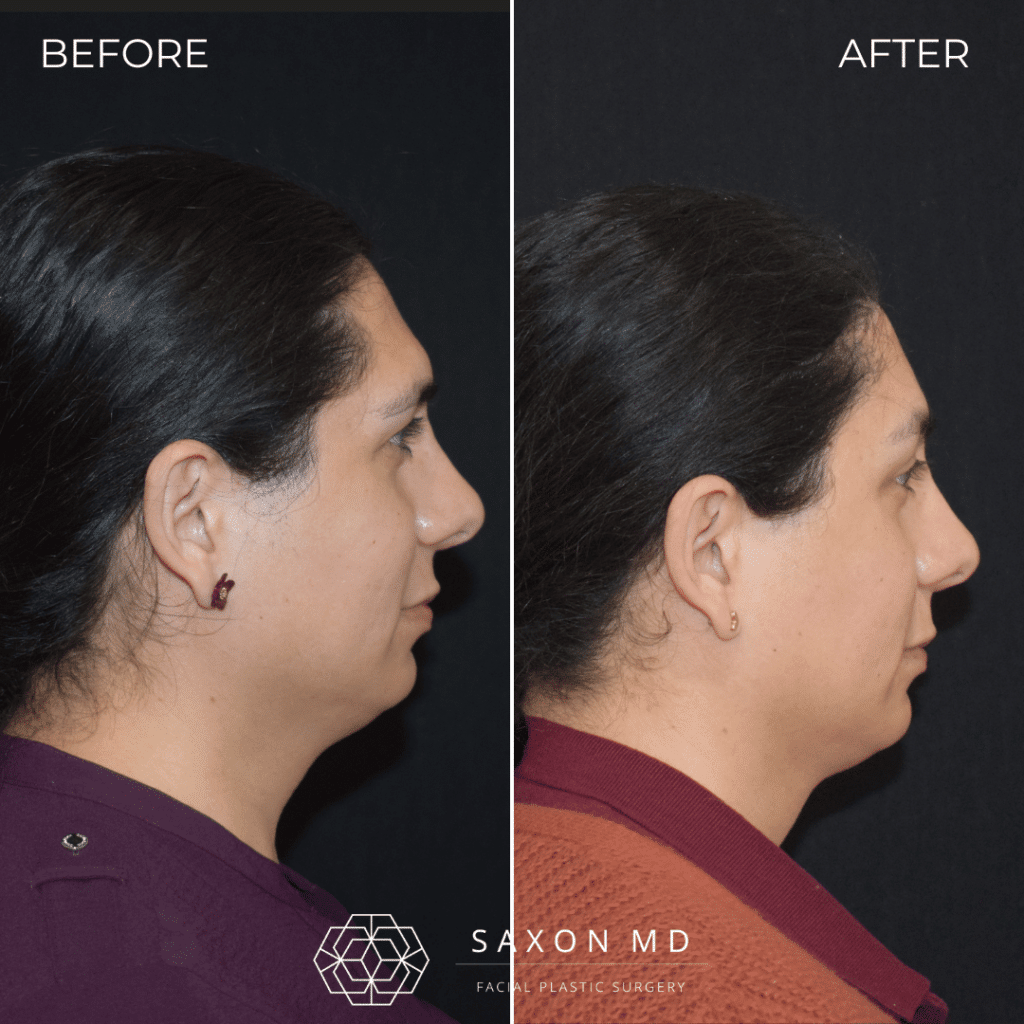 Brow Bone Reduction 59 brow bone reduction before and after photos from Saxon MD in Austin and Dallas, TX