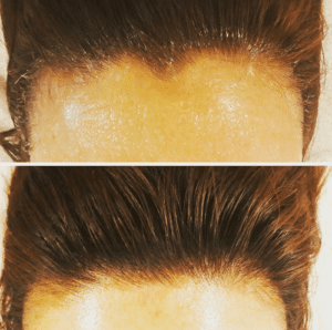 scalp microblading, how to get a smaller forehead
