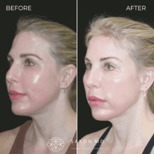 brow bone reduction before and after