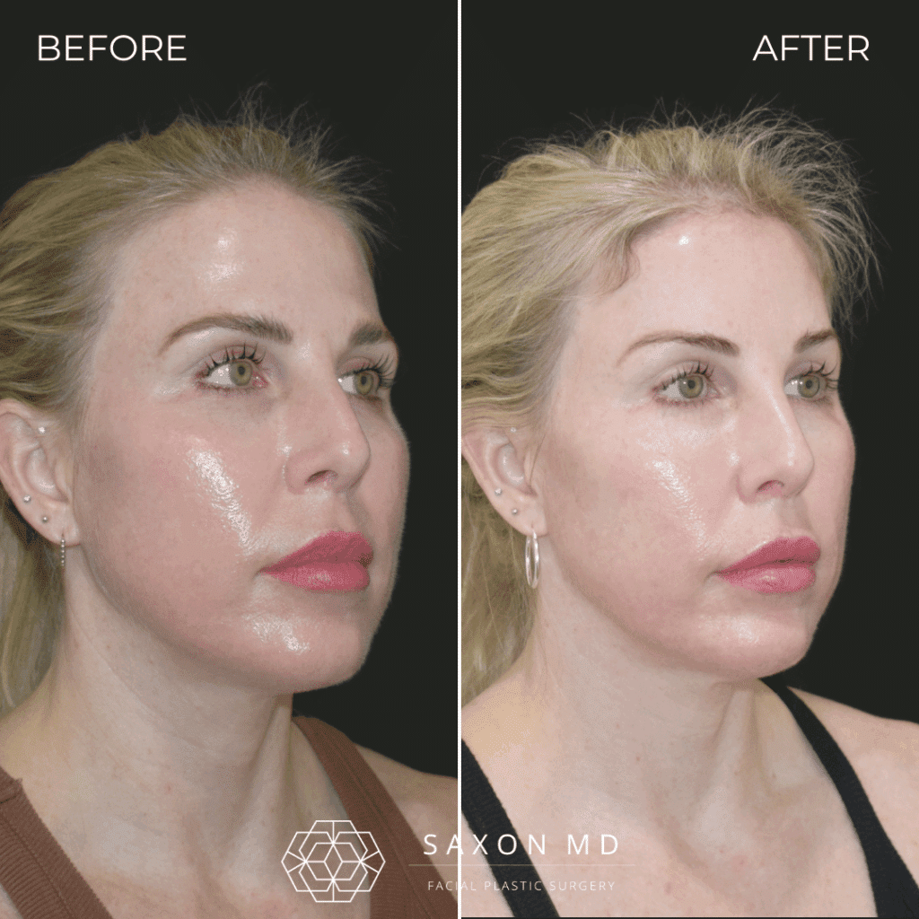 Brow Bone Reduction 61 brow bone reduction before and after