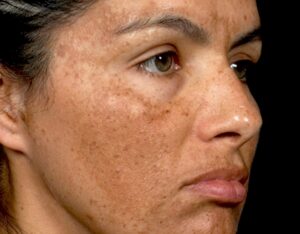melasma, pregnancy mask