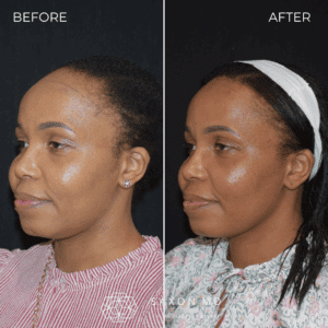 hairline lowering before and after; forehead reduction before and after at Saxon MD in Austin and Dallas, TX; receding hairline women