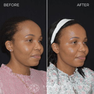 hairline lowering before and after; forehead reduction before and after at Saxon MD in Austin and Dallas, TX; people with a big forehead