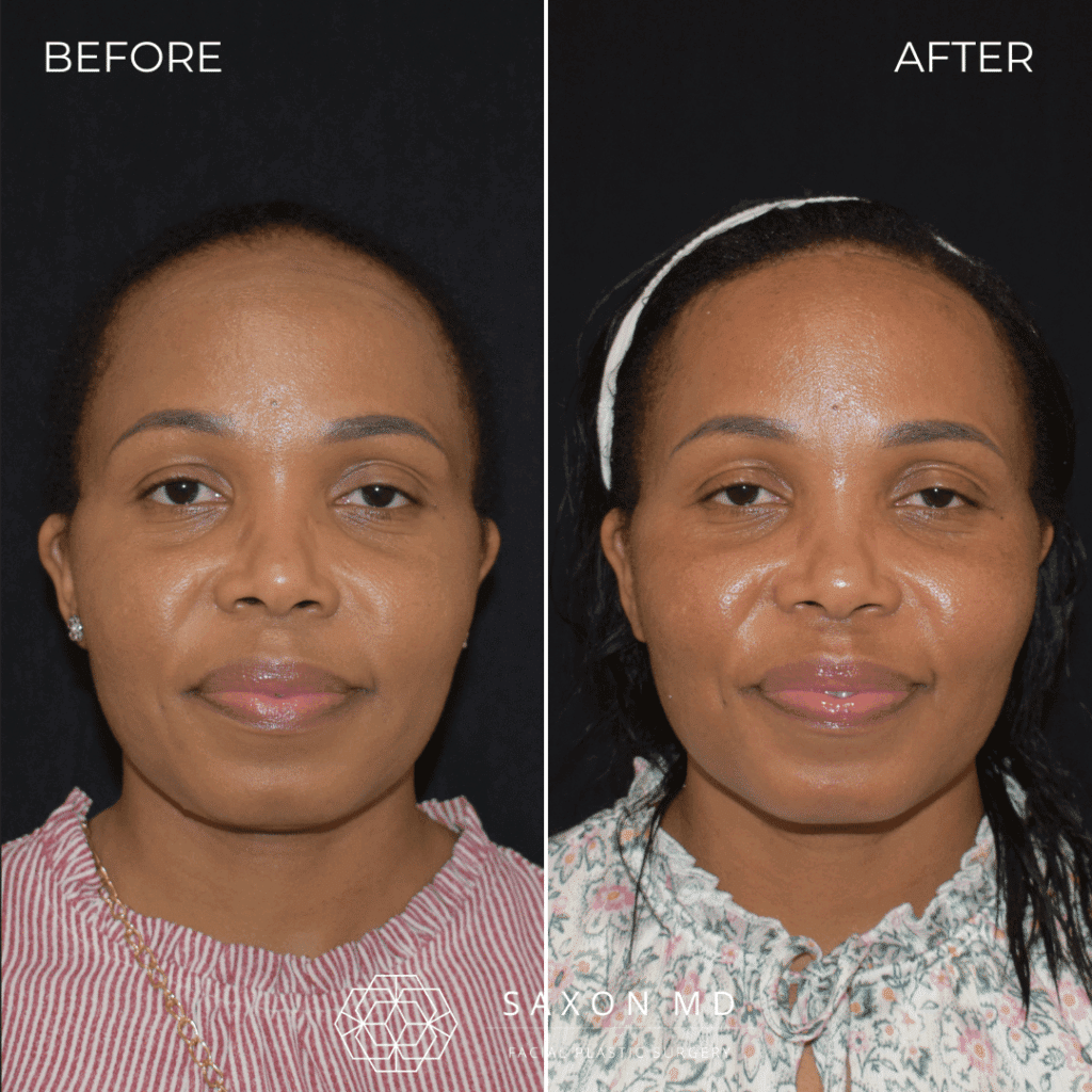Forehead Reduction (Hairline Lowering) 66 hairline lowering before and after; forehead reduction before and after at Saxon MD in Austin and Dallas, TX