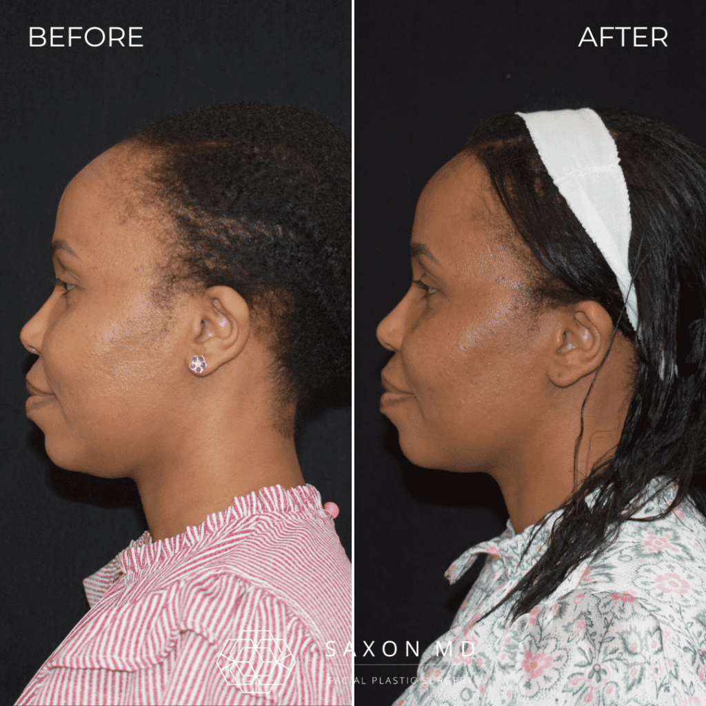 Forehead Reduction (Hairline Lowering) 67 hairline lowering before and after; forehead reduction before and after at Saxon MD in Austin and Dallas, TX