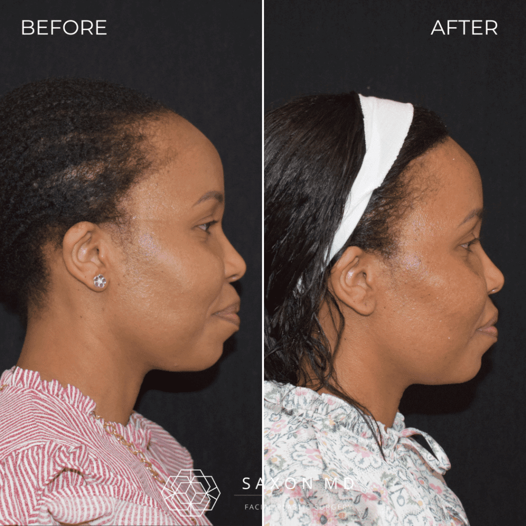 Forehead Reduction (Hairline Lowering) 68 hairline lowering before and after; forehead reduction before and after at Saxon MD in Austin and Dallas, TX