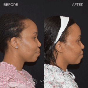 hairline lowering before and after; forehead reduction before and after at Saxon MD in Austin and Dallas, TX; forehead reduction vs hair transplant