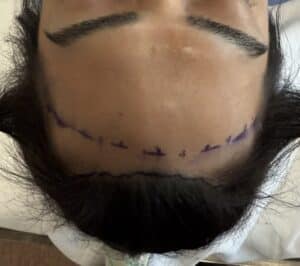 incision for hairline lowering; pretricheal incision; straight hairline