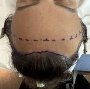 Incision Design Matters: Why a Perfectly Straight Hairline Looks Fake in Forehead Reduction Surgery 6 pretricheal incision for hairline lowering; avoiding a straight hairline