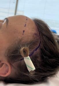 hairline lowering incision; straight hairline