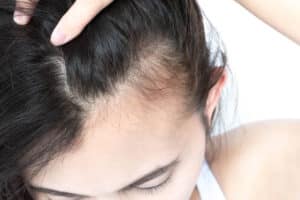 straight hairline