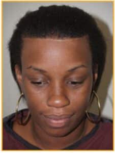 straight hairline