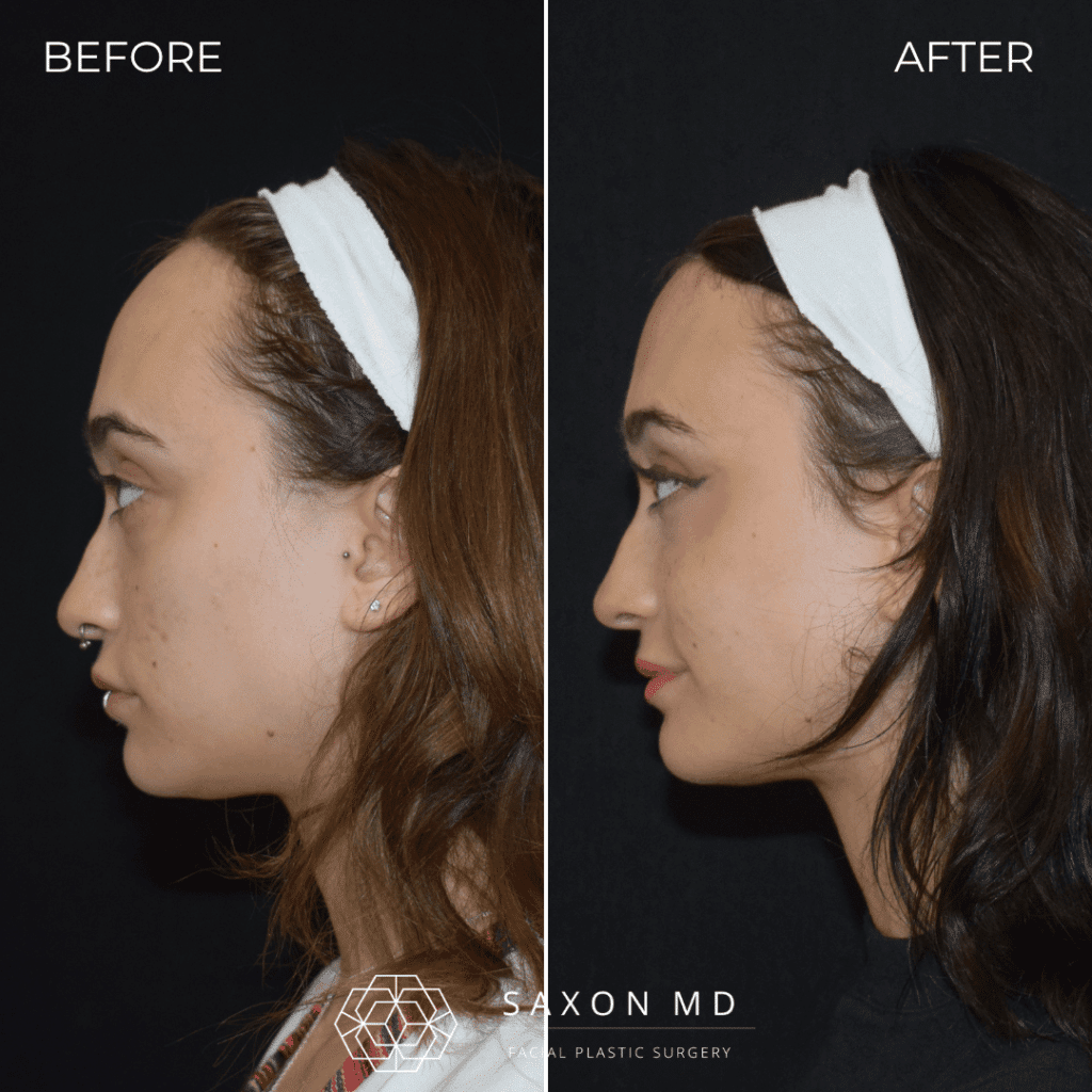 forehead reduction before and after; hairline lowering at Saxon MD in Austin and Dallas, TX