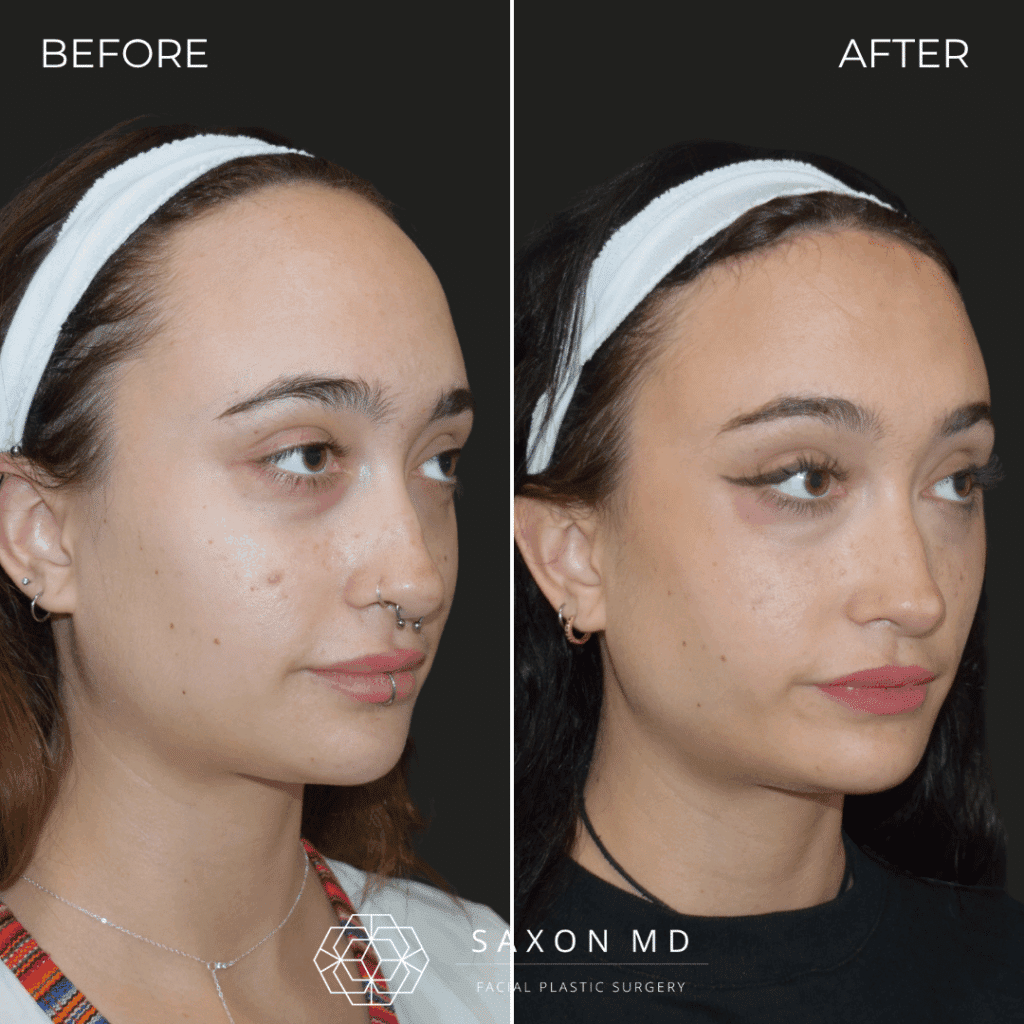 forehead reduction before and after; hairline lowering at Saxon MD in Austin and Dallas, TX
