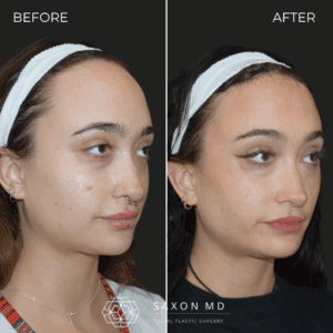 forehead reduction before and after; hairline lowering at Saxon MD in Austin and Dallas, TX; big forehead; forehead reduction surgery cost