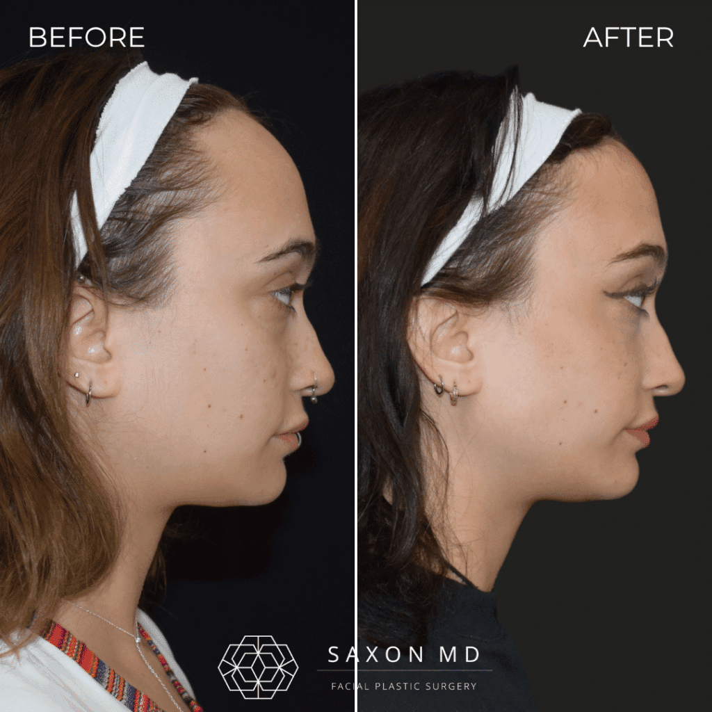 forehead reduction before and after; hairline lowering at Saxon MD in Austin and Dallas, TX