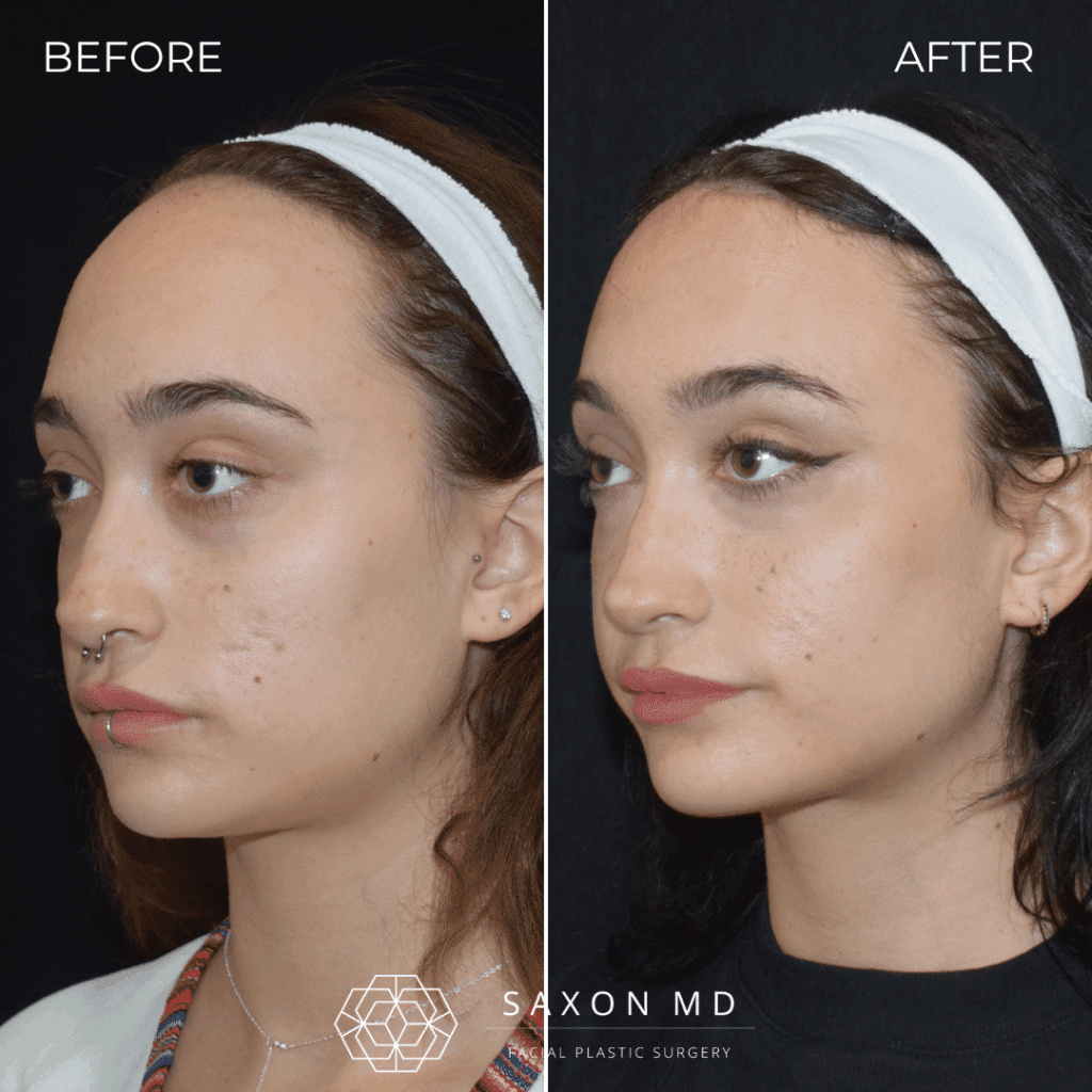 forehead reduction before and after; hairline lowering at Saxon MD in Austin and Dallas, TX