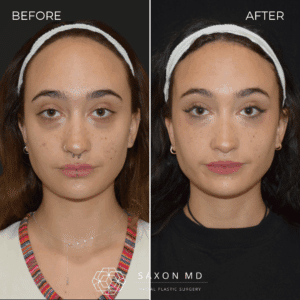 forehead reduction before and after; hairline lowering at Saxon MD in Austin and Dallas, TX; forehead reduction vs hair transplant