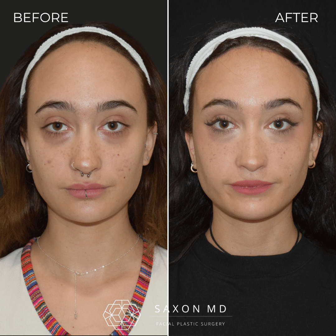 Forehead Reduction Vs Hair Transplant For Hairline Lowering