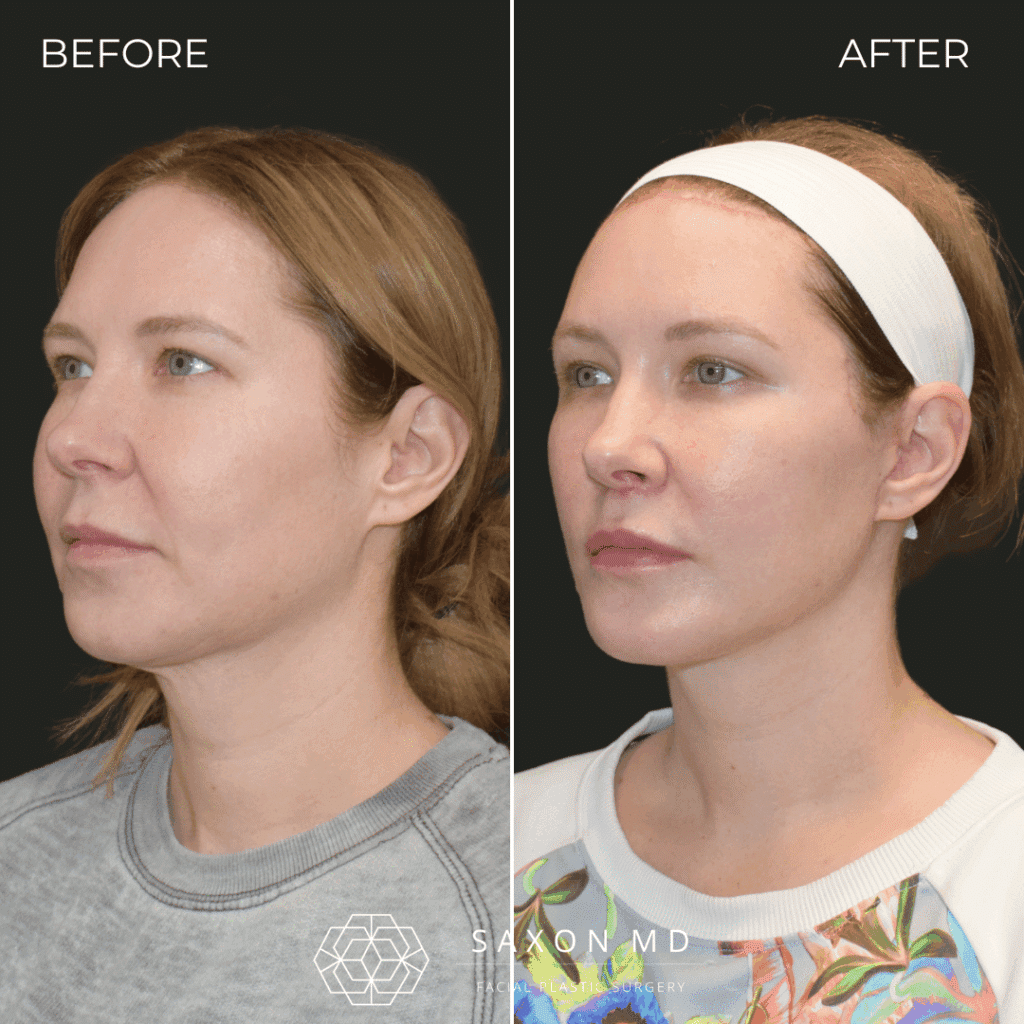 deep plane facelift before and after; facelift austin; facelift dallas
