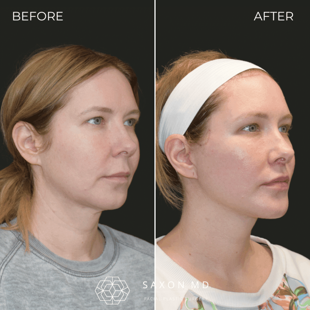 deep plane facelift before and after; facelift austin; facelift dallas